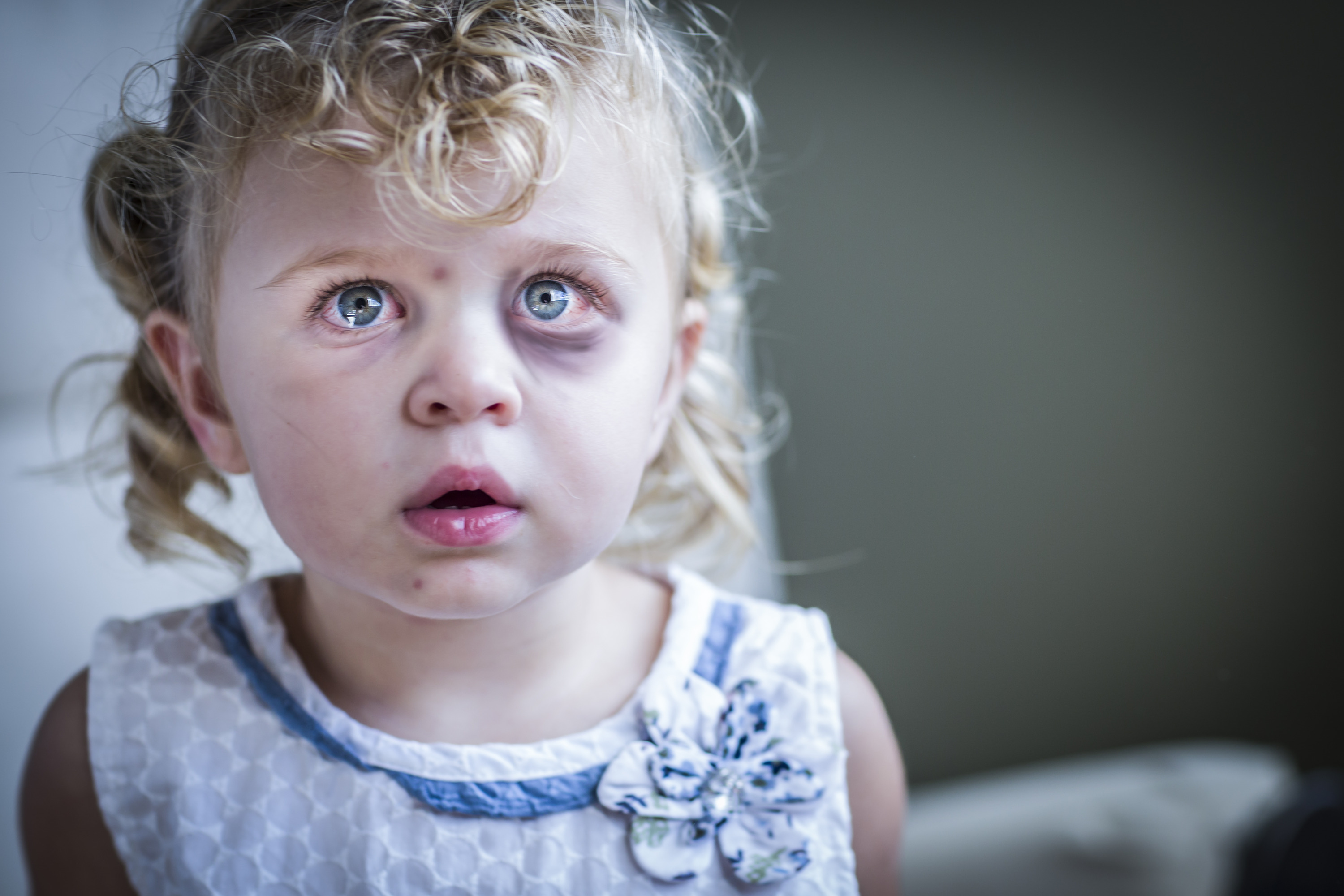 Sad and Frightened Little Girl with Bloodshot and Bruised Eyes.